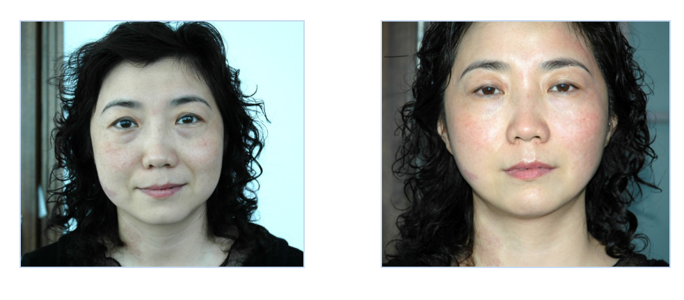 Thermage Machine Treatment Before and After