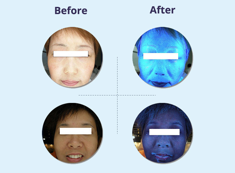 Skin Analysis Machine Scan Before After