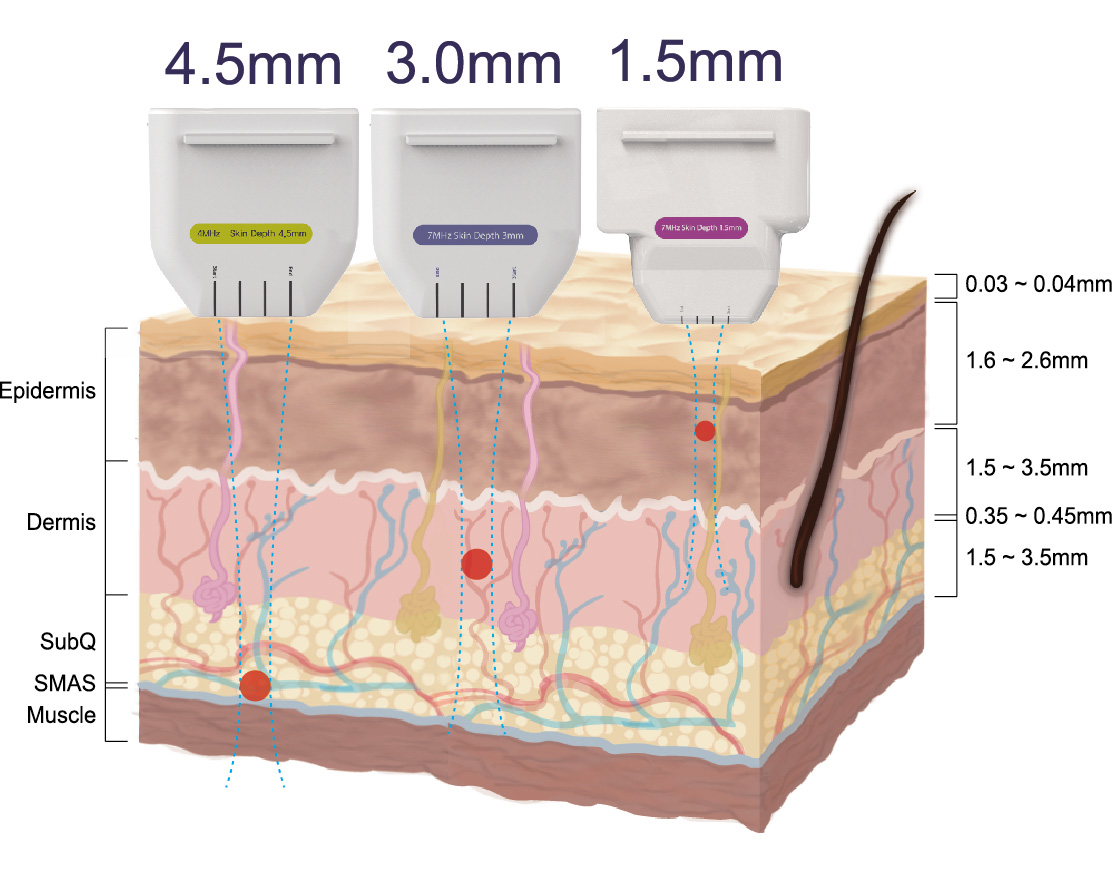 4.5mm 3.0mm 1.5mm Cartridges Treatment Depth