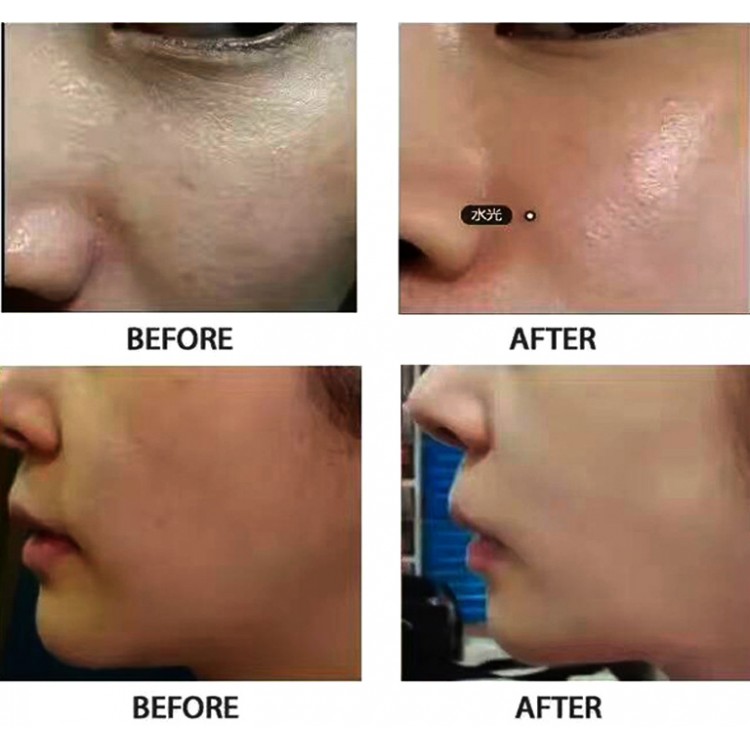 Laser Peel Treatment Before and After