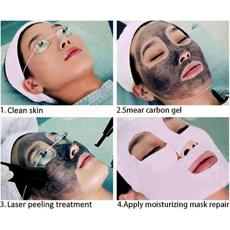 Laser Peeling Treatment